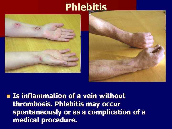 Phlebitis n Is inflammation of a vein without thrombosis. Phlebitis may occur spontaneously or