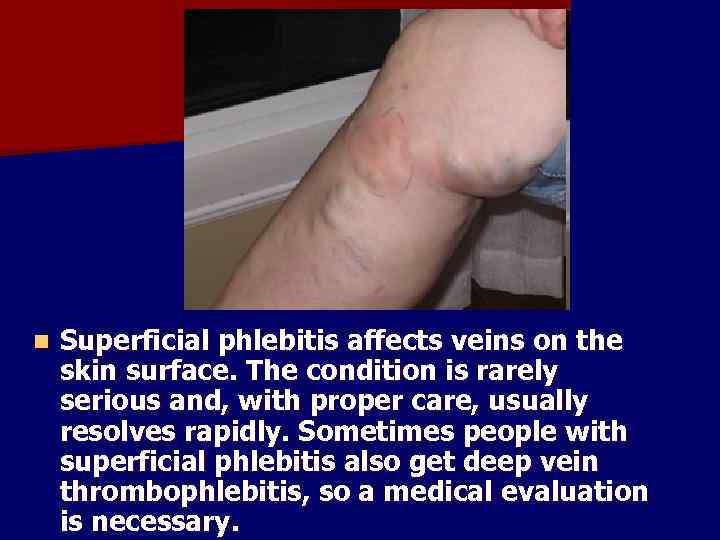 n Superficial phlebitis affects veins on the skin surface. The condition is rarely serious