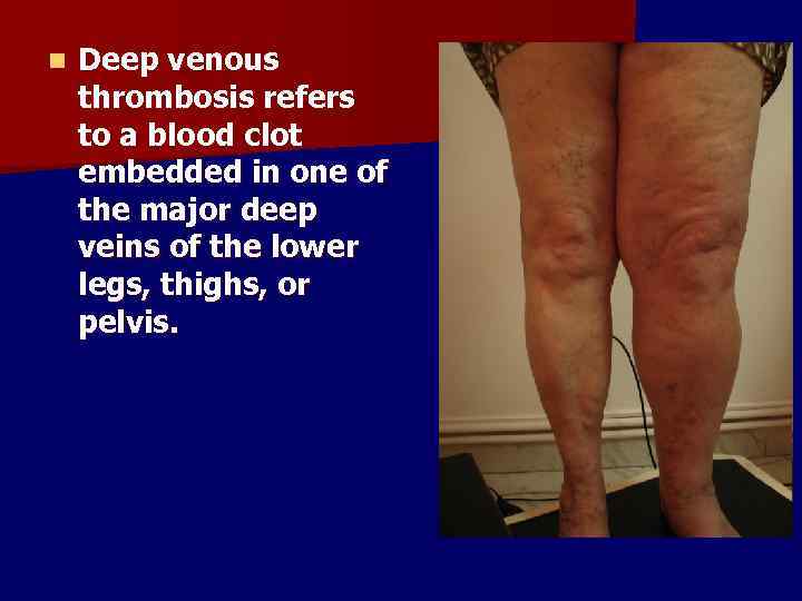 n Deep venous thrombosis refers to a blood clot embedded in one of the
