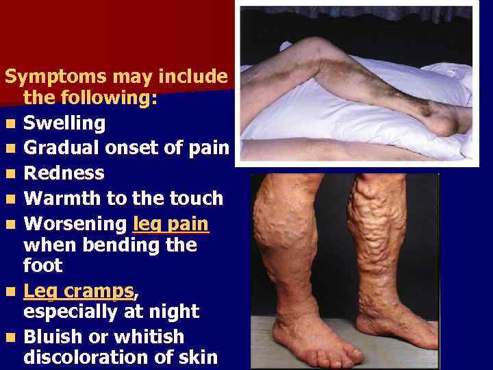 Symptoms may include the following: n Swelling n Gradual onset of pain n Redness