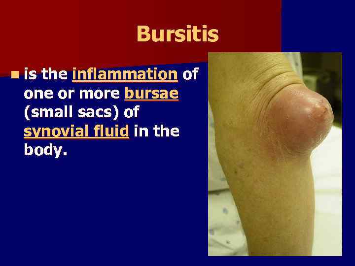 Bursitis n is the inflammation of one or more bursae (small sacs) of synovial