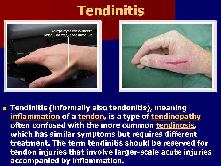 Tendinitis n Tendinitis (informally also tendonitis), meaning inflammation of a tendon, is a type
