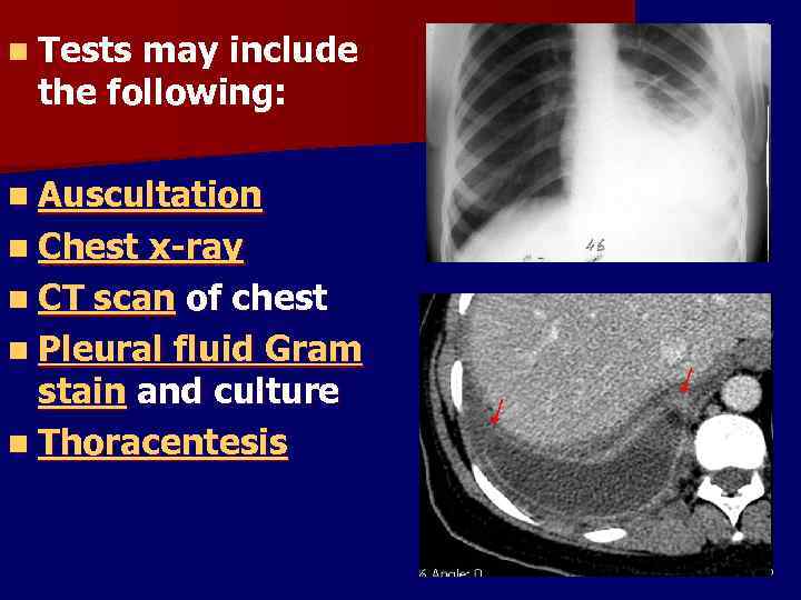 n Tests may include the following: n Auscultation n Chest x-ray n CT scan