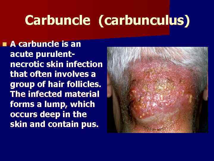Carbuncle (саrbunculus) n A carbuncle is an A carbuncle acute purulentnecrotic skin infection that