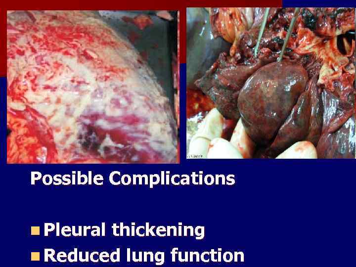 Possible Complications n Pleural thickening n Reduced lung function 