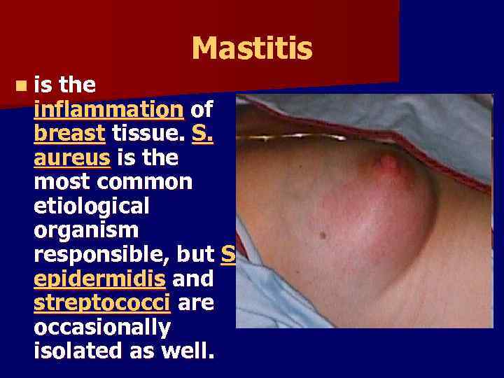 Mastitis n is the inflammation of breast tissue. S. aureus is the most common