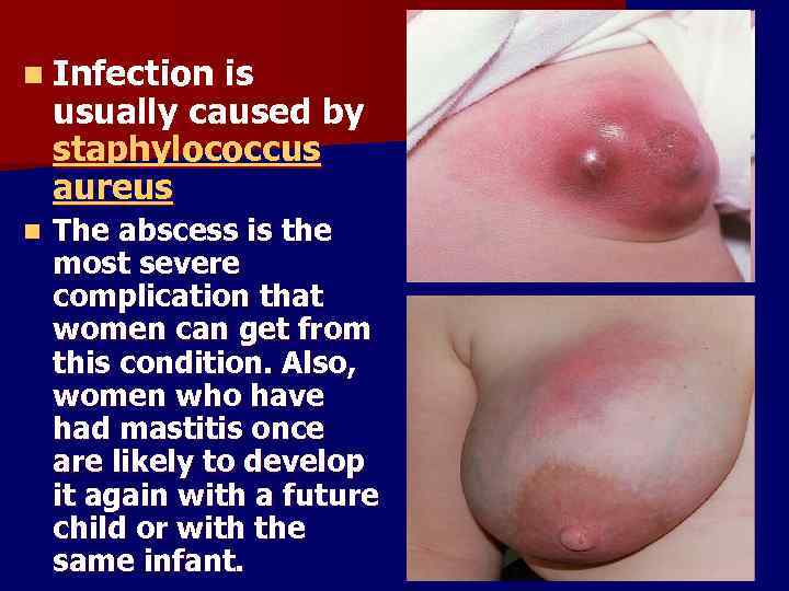 n Infection is usually caused by staphylococcus aureus n The abscess is the most