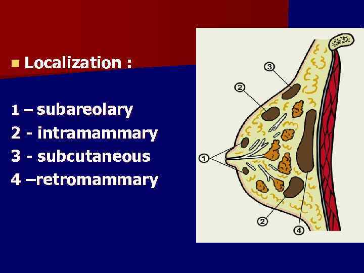 n Localization : 1 – subareolary 2 - intramammary 3 - subcutaneous 4 –retromammary