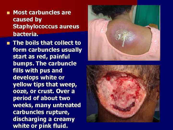 Most carbuncles are caused by Staphylococcus aureus bacteria. n The boils that collect to