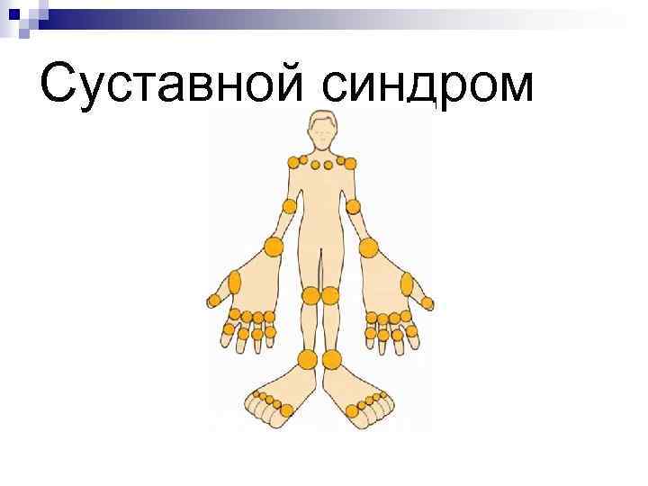 Суставной синдром 