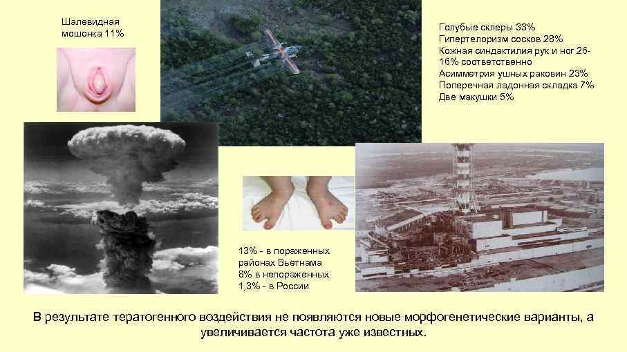 Шалевидная мошонка 11% Голубые склеры 33% Гипертелоризм сосков 28% Кожная синдактилия рук и ног