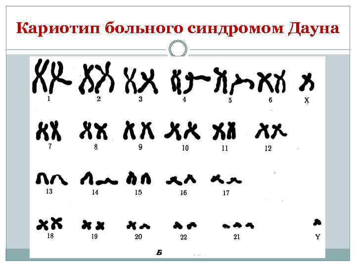 Кариотип дауна. Кариотип человека с синдромом Дауна. Кариотип больных с синдромом Дауна. Кариотип при синдроме Дауна. Кариотип мужчины с синдромом Дауна.