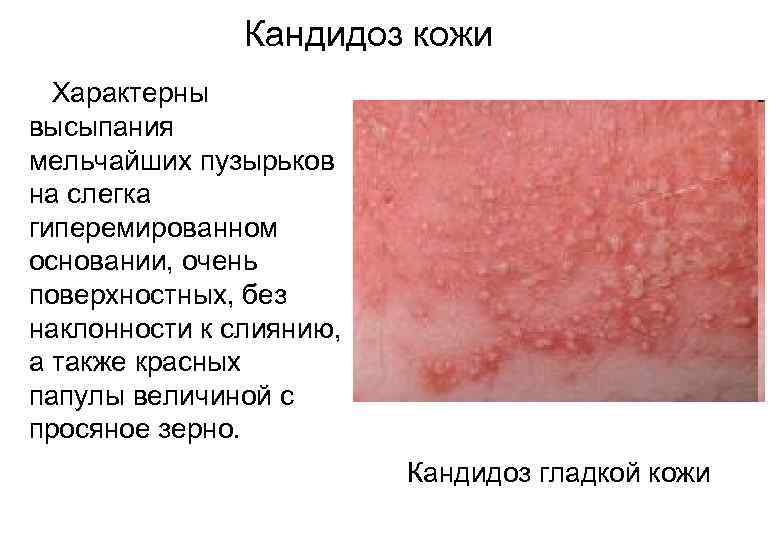 Кандидоз кожи Характерны высыпания мельчайших пузырьков на слегка гиперемированном основании, очень поверхностных, без наклонности