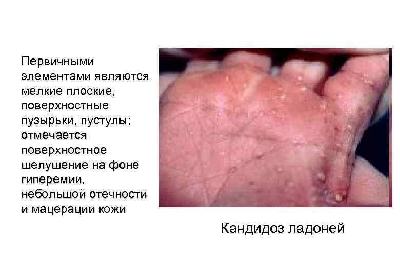 Первичными элементами являются мелкие плоские, поверхностные пузырьки, пустулы; отмечается поверхностное шелушение на фоне гиперемии,