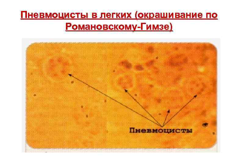 Пневмоцисты в легких (окрашивание по Романовскому-Гимзе) 