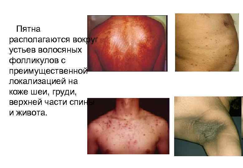  Пятна располагаются вокруг устьев волосяных фолликулов с преимущественной локализацией на коже шеи, груди,