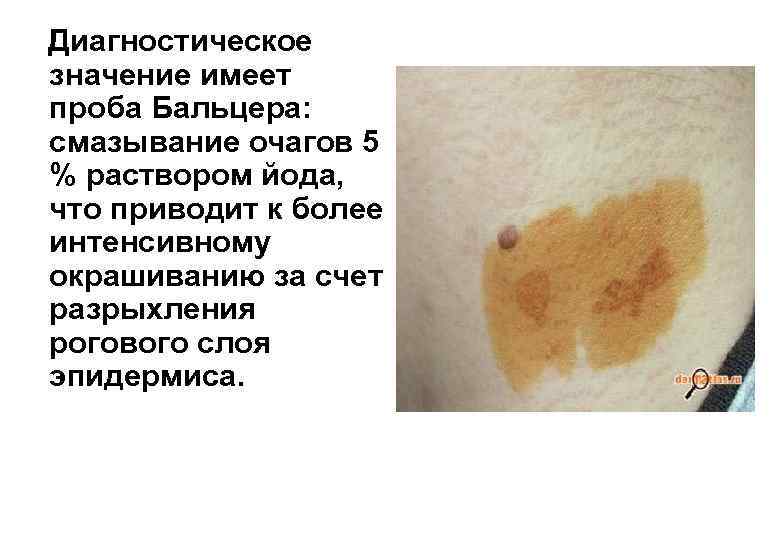 Диагностическое значение имеет проба Бальцера: смазывание очагов 5 % раствором йода, что приводит к