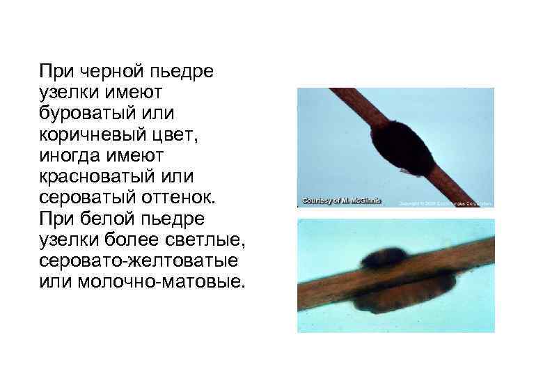 При черной пьедре узелки имеют буроватый или коричневый цвет, иногда имеют красноватый или сероватый