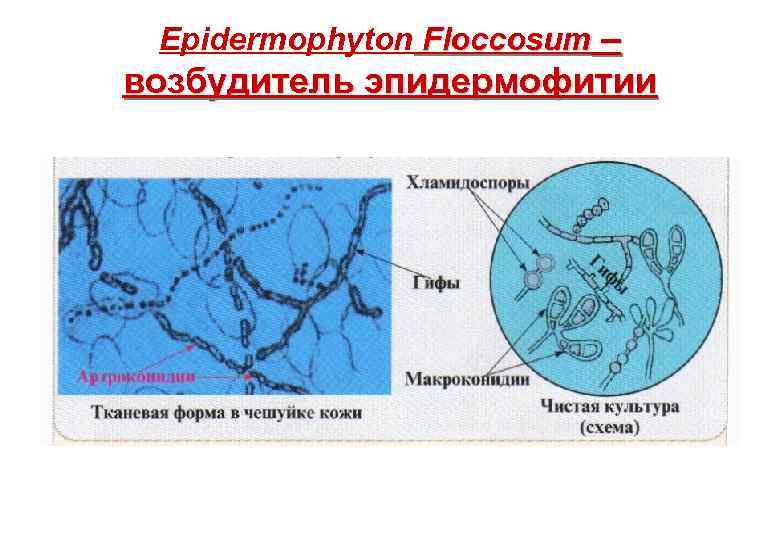 Epidermophyton Floccosum – возбудитель эпидермофитии 
