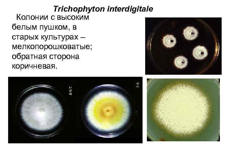 Trichophyton interdigitale Колонии с высоким белым пушком, в старых культурах – мелкопорошковатые; обратная сторона
