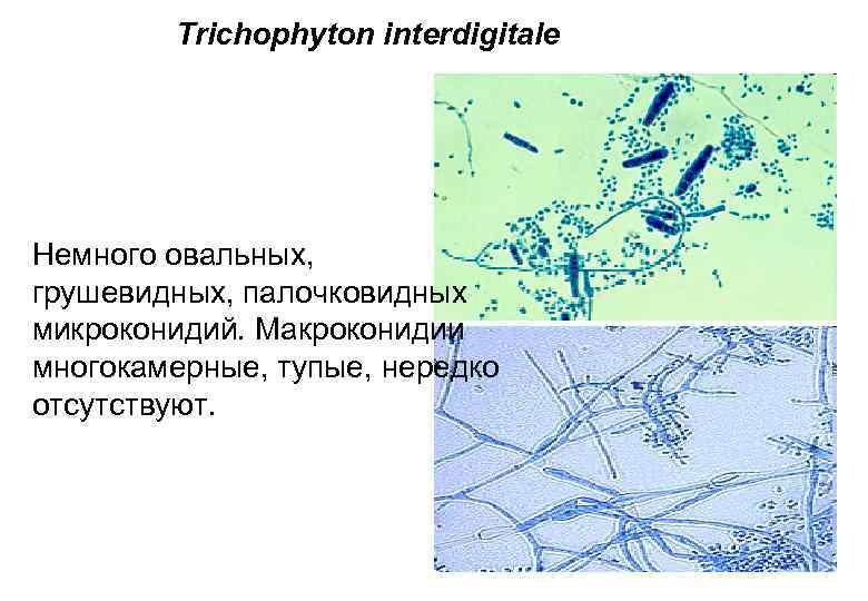 Trichophyton interdigitale Немного овальных, грушевидных, палочковидных микроконидий. Макроконидии многокамерные, тупые, нередко отсутствуют. 