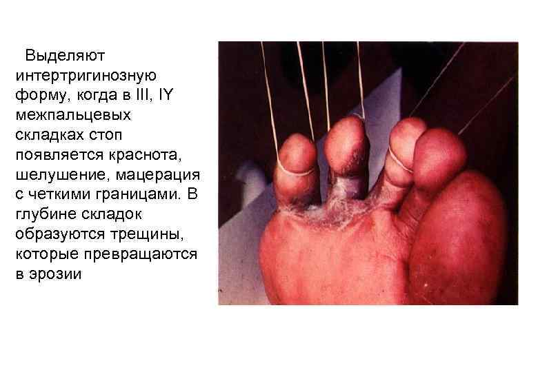  Выделяют интертригинозную форму, когда в III, IY межпальцевых складках стоп появляется краснота, шелушение,