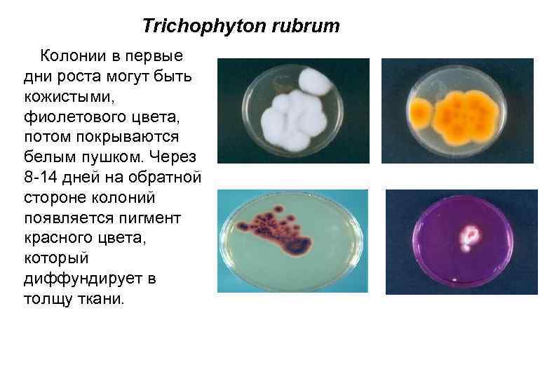 Trichophyton rubrum Колонии в первые дни роста могут быть кожистыми, фиолетового цвета, потом покрываются