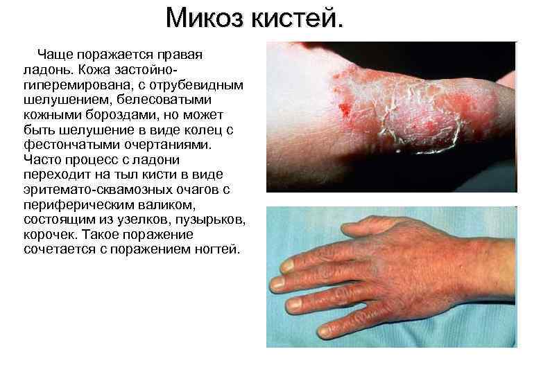 Микоз кистей. Чаще поражается правая ладонь. Кожа застойногиперемирована, с отрубевидным шелушением, белесоватыми кожными бороздами,