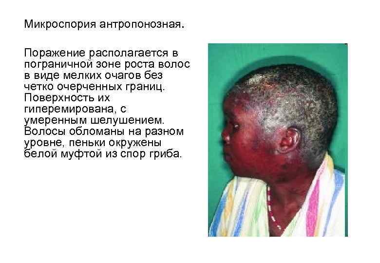  Микроспория антропонозная. Поражение располагается в пограничной зоне роста волос в виде мелких очагов