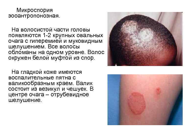  Микроспория зооантропонозная. На волосистой части головы появляются 1 -2 крупных овальных очага с