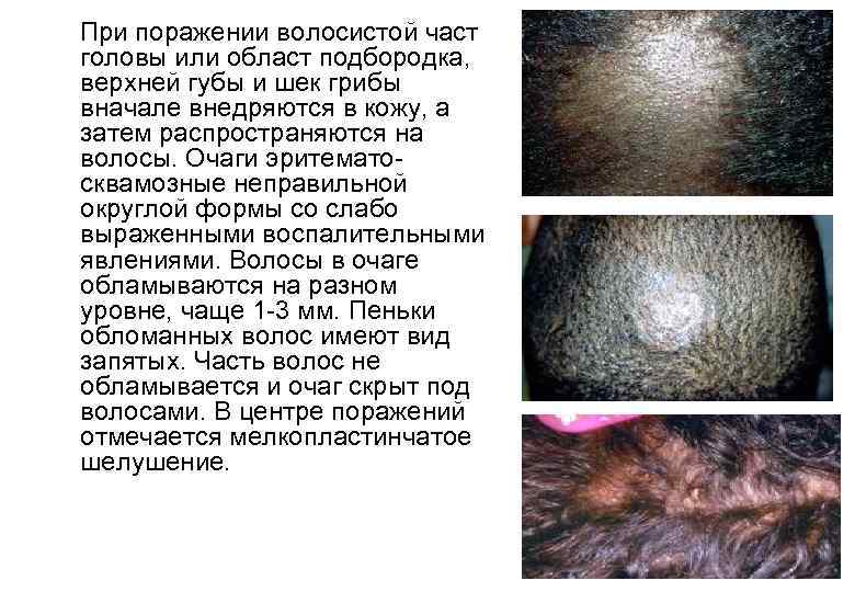  При поражении волосистой част головы или област подбородка, верхней губы и шек грибы