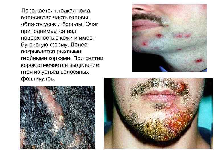  Поражается гладкая кожа, волосистая часть головы, область усов и бороды. Очаг приподнимается над