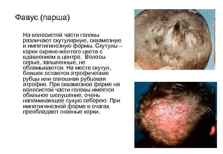  Фавус (парша) На волосистой части головы различают скутулярную, сквамозную и импетигинозную формы. Скутулы