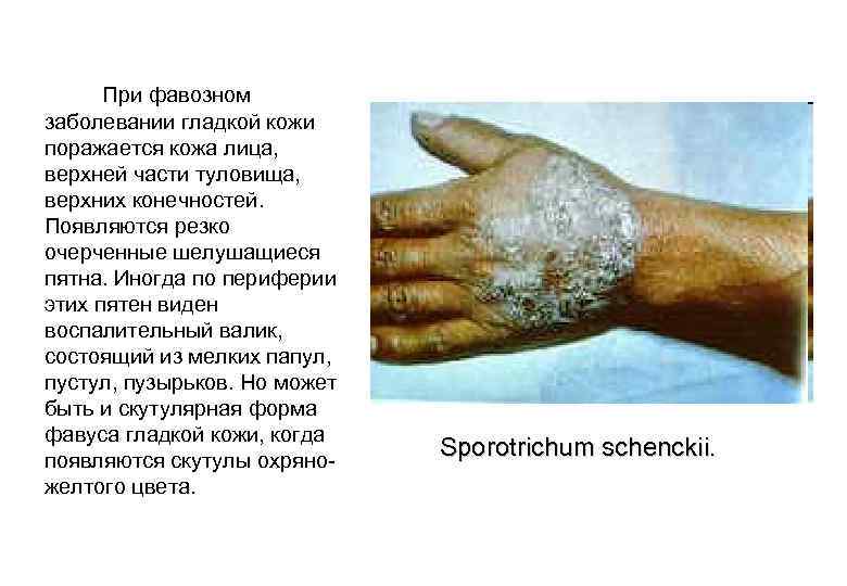  При фавозном заболевании гладкой кожи поражается кожа лица, верхней части туловища, верхних конечностей.