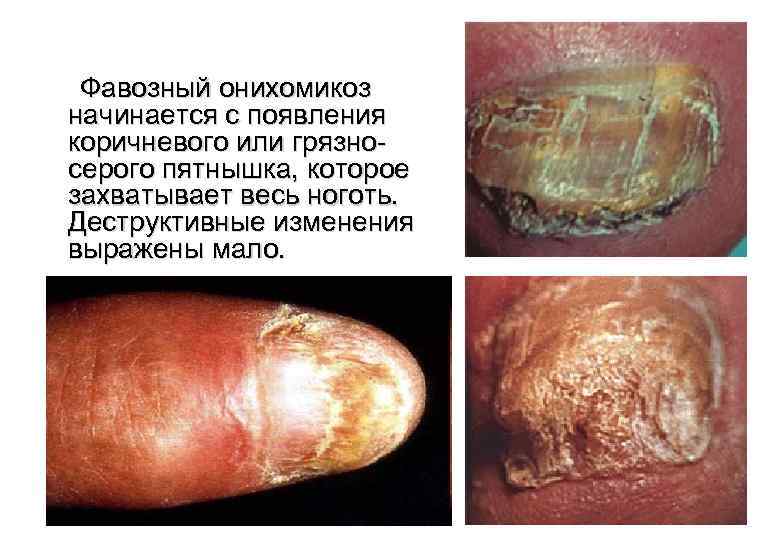  Фавозный онихомикоз начинается с появления коричневого или грязносерого пятнышка, которое захватывает весь ноготь.