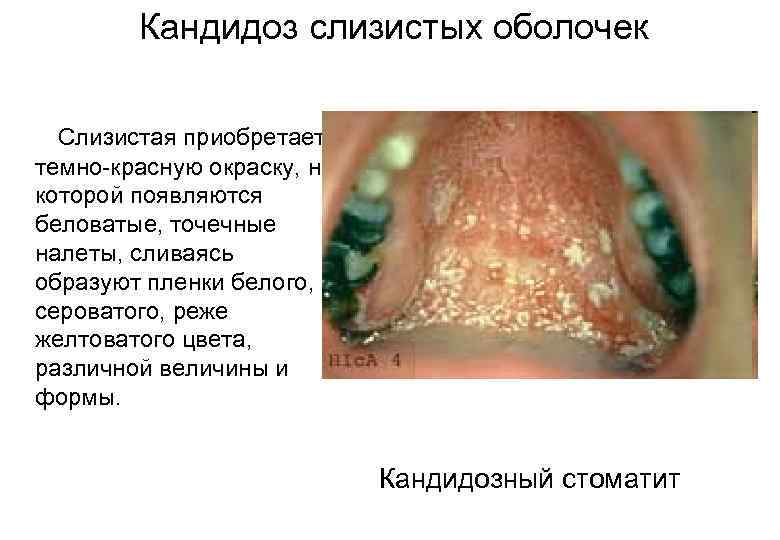 Кандидоз слизистых оболочек Cлизистая приобретает темно-красную окраску, на которой появляются беловатые, точечные налеты, сливаясь