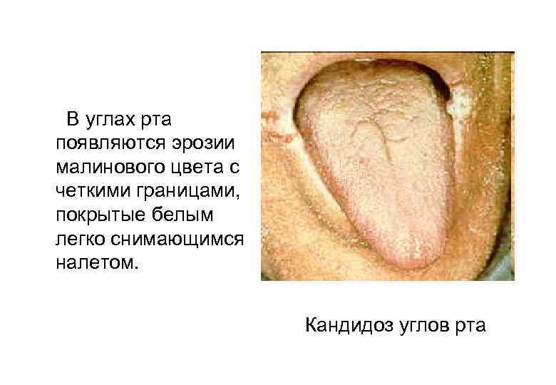  В углах рта появляются эрозии малинового цвета с четкими границами, покрытые белым легко