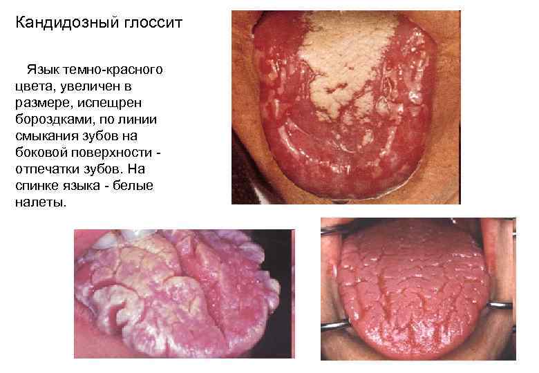 Кандидозный глоссит Язык темно-красного цвета, увеличен в размере, испещрен бороздками, по линии смыкания зубов