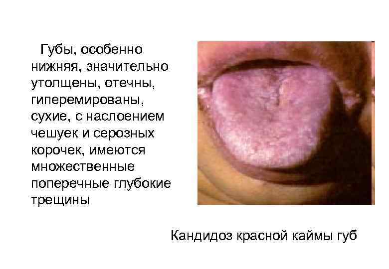  Губы, особенно нижняя, значительно утолщены, отечны, гиперемированы, сухие, с наслоением чешуек и серозных