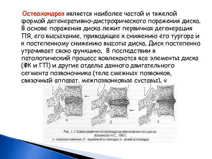 Остеохондроз является наиболее частой и тяжелой формой дегенеративно-дистрофического поражения диска. В основе поражения диска