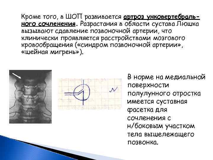 Кроме того, в ШОП развивается артроз унковертебрального сочленения. Разрастания в области сустава Люшка вызывают