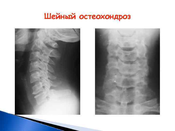 Шейный остеохондроз 