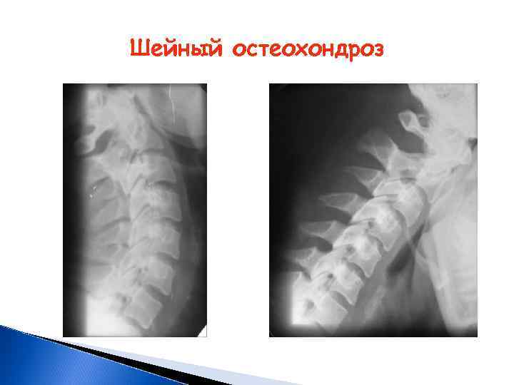 Шейный остеохондроз 