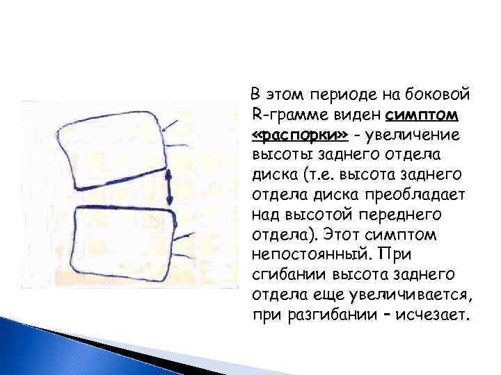  В этом периоде на боковой R-грамме виден симптом «распорки» - увеличение высоты заднего
