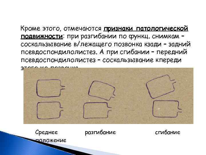  Кроме этого, отмечаются признаки патологической подвижности: при разгибании по функц. снимкам – соскальзывание