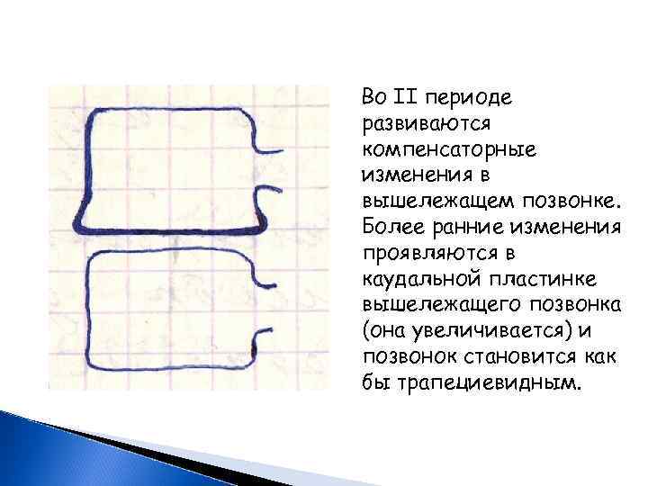  Во II периоде развиваются компенсаторные изменения в вышележащем позвонке. Более ранние изменения проявляются