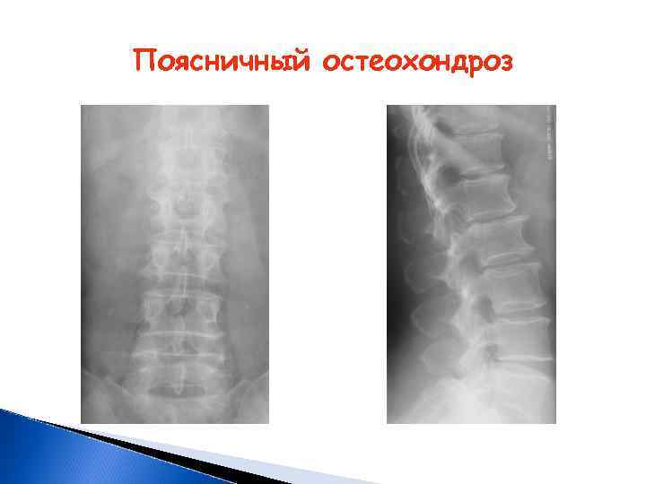 Поясничный остеохондроз 