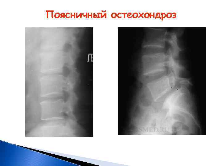 Поясничный остеохондроз 