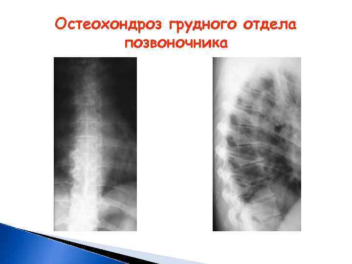 Остеохондроз грудного отдела позвоночника 