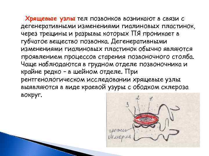 Хрящевые узлы тел позвонков возникают в связи с дегенеративными изменениями гиалиновых пластинок, через трещины